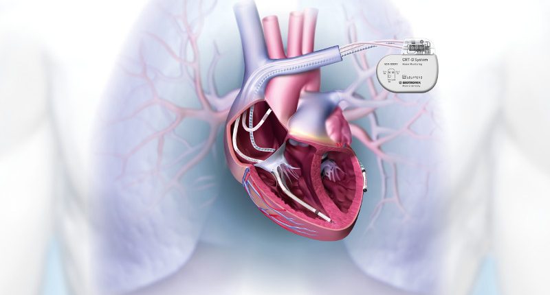 nahla-srdecni-smrt-a-uloha-implantabilnich-defibrilatoru-v-jeji-prevenci.jpg