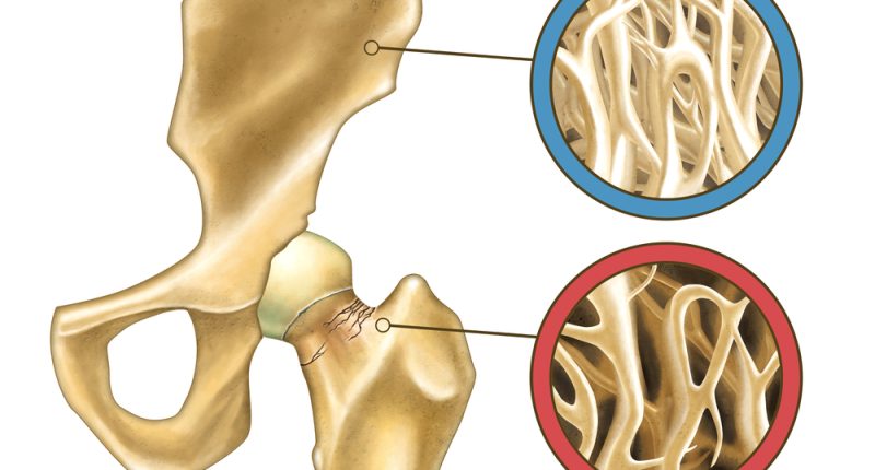 osteoporoza-nenapadne-onemocneni-ktere-lame-kosti.jpg