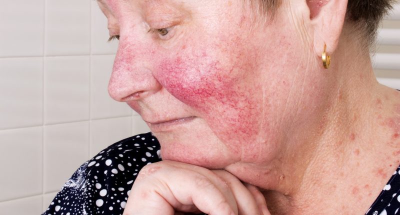 rosacea-nebo-li-ruzovka.jpg