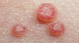 Molusky (Molluscum contagiosum)